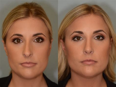 septorhinoplasty before and after