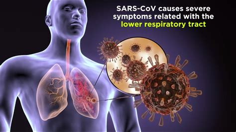 severe acute respiratory syndrome sars symptoms