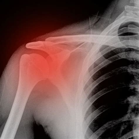 shoulder fractures shoulder fractures Epub