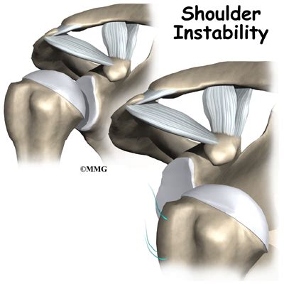 shoulder instability shoulder instability Doc