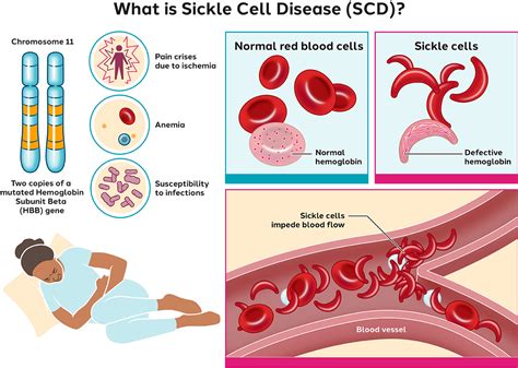 sickle cell disease twenty first century medical library Epub