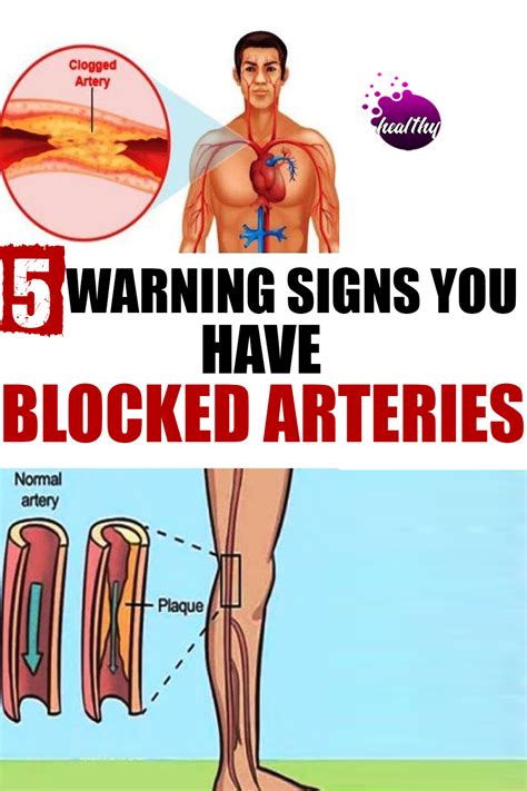 signs of blocked arteries in heart