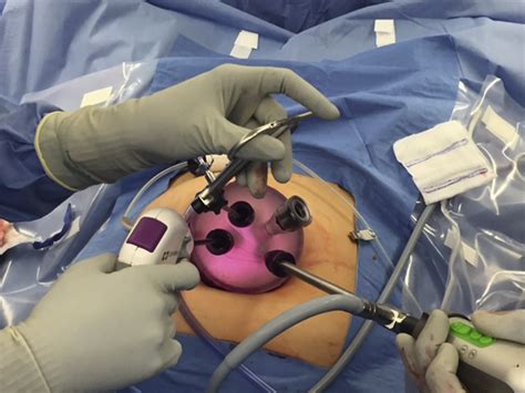 single port laparoscopic surgery in gynecology Epub