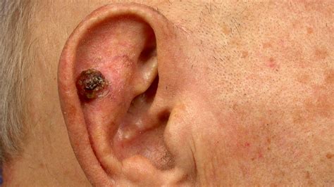 skin cancer on ear photos