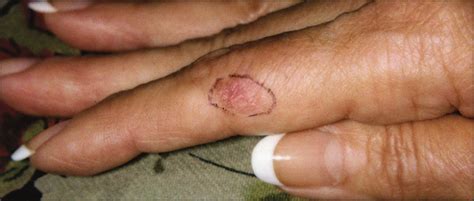 skin cancer on finger