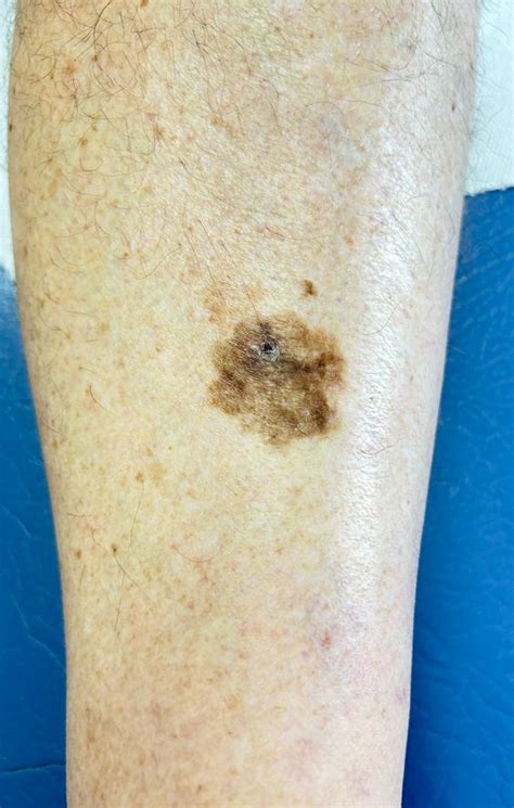 skin cancer on leg pictures