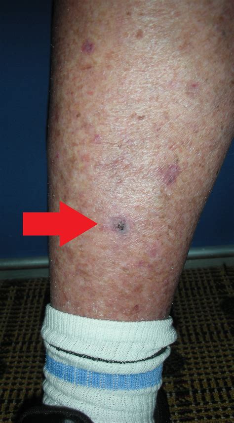 skin cancer on legs images