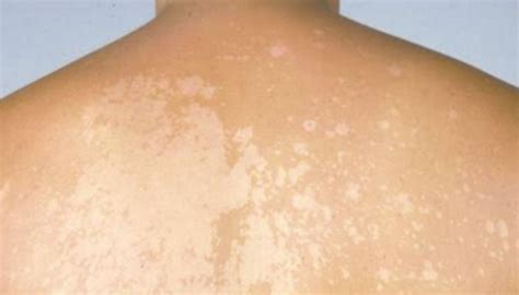 skin disorder white patches