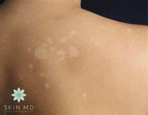 skin fungus white spots