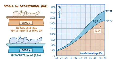 small for gestational age small for gestational age PDF
