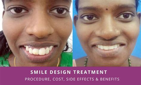 smile design treatment cost in india