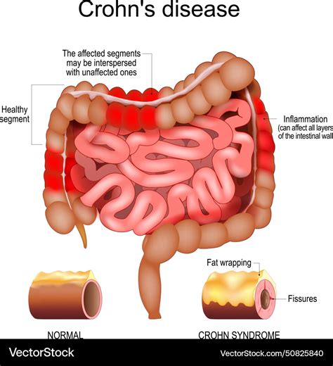 sores in the intestines