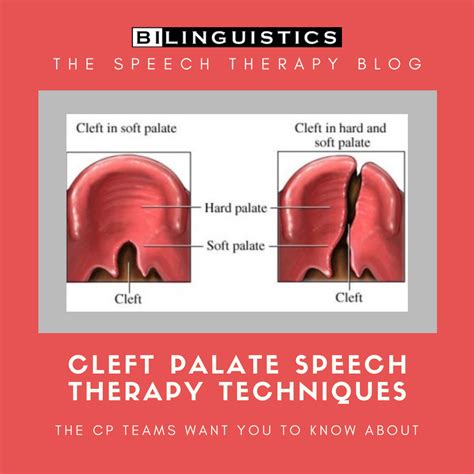 speech therapy iep goals for cleft palate Reader