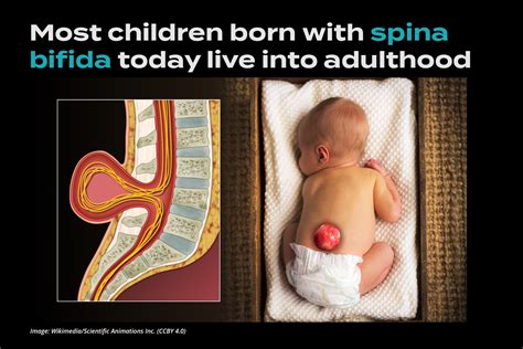 spina bifida life expectancy