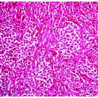 spindle cell sarcoma in dogs