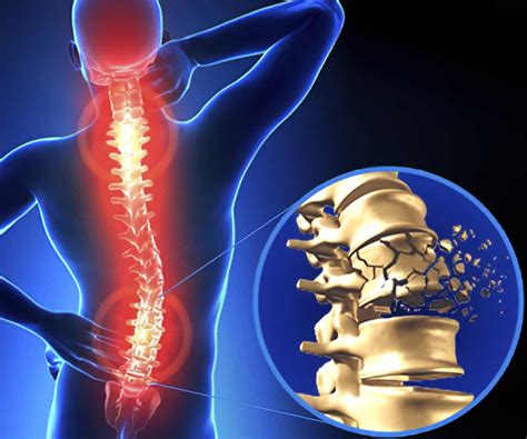 spine and spinal cord trauma spine and spinal cord trauma Doc