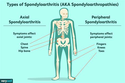 spondyl o medical term