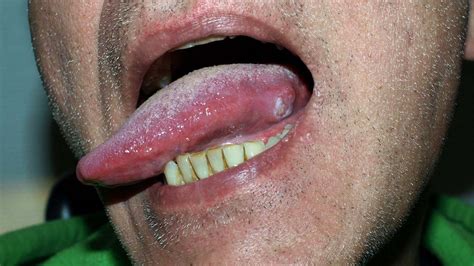 squamous cell cancer tongue