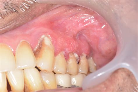 squamous cell carcinoma gums