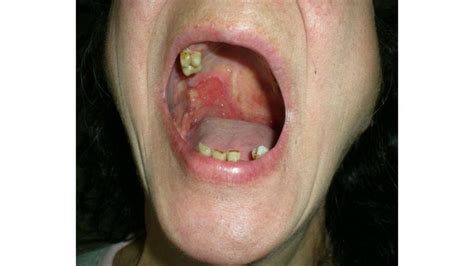 squamous cell carcinoma mouth