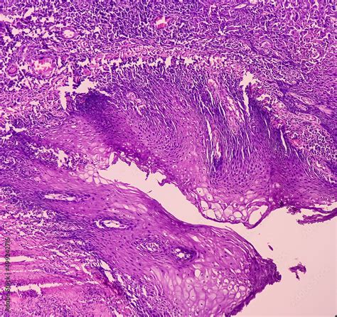 squamous cell carcinoma tonsil