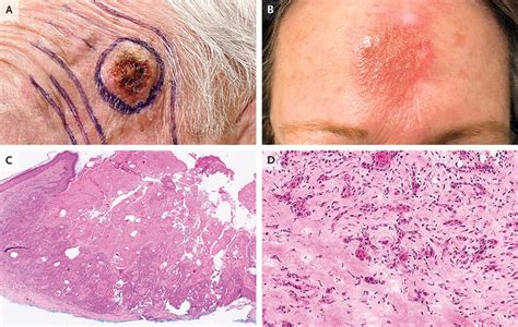 stage 1 squamous cell cancer