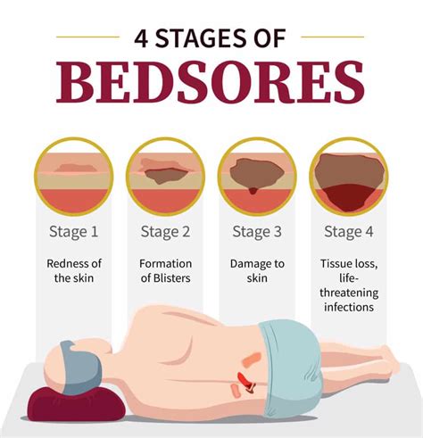 stage 3 bedsore pictures