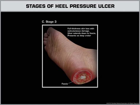 stage 3 pressure ulcer pictures