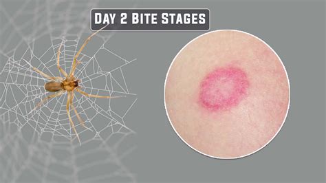 stages of a brown recluse bite