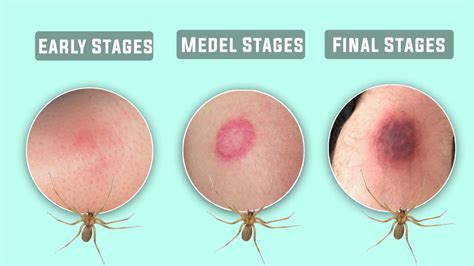 stages of brown recluse spider bite