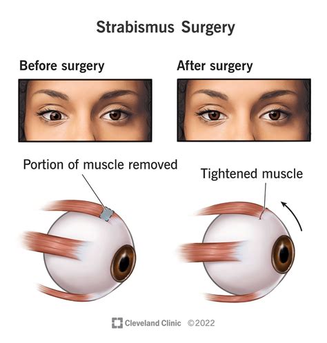strabismus surgery strabismus surgery Doc