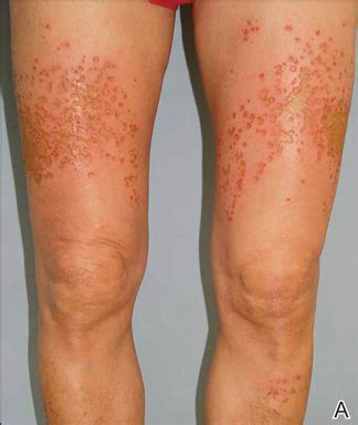 sulfur spring dermatitis