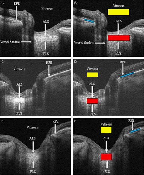 swept source optical coherence tomography swept source optical coherence tomography Reader