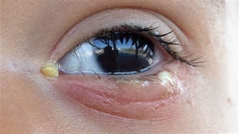 swollen eye with discharge