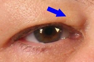 swollen inner corner of eye