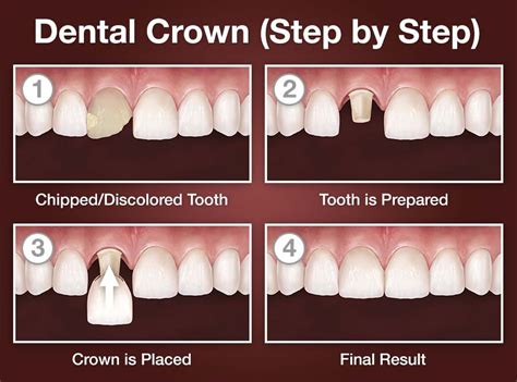 teeth cap price