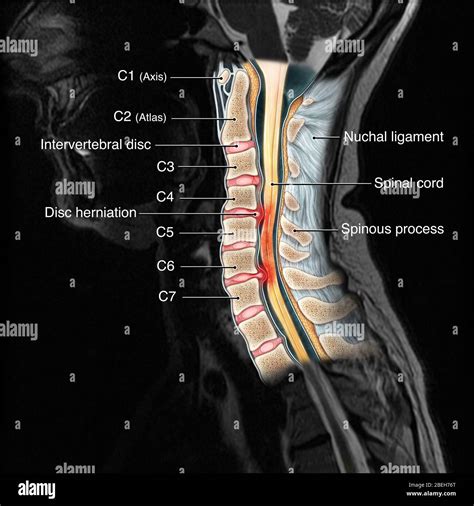 the radiology of acute cervical spine trauma PDF