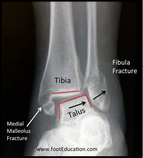 the unstable ankle the unstable ankle Reader