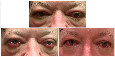 thyroid eye disease icd 10