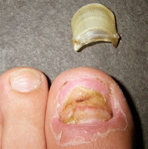 toenails falling off cancer