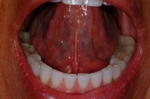 tongue cancer under tongue