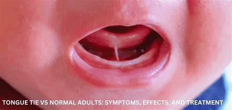 tongue tie vs normal pictures