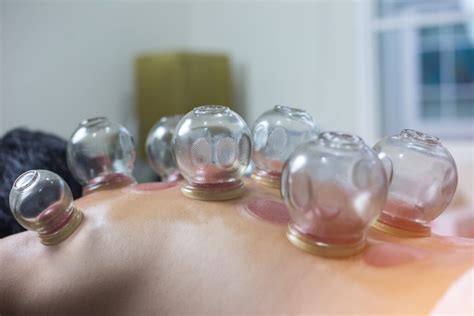 traditional chinese medicine cupping therapy PDF