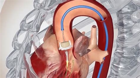 transcatheter aortic valve replacement Doc
