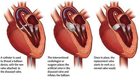 transcatheter aortic valve replacement Doc