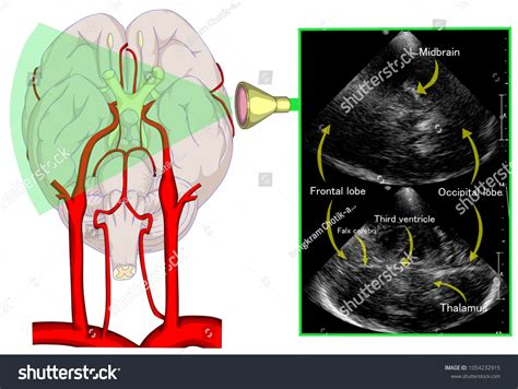 transcranial doppler sonography PDF