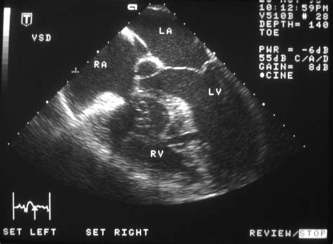 transesophageal echocardiography for congenital heart disease Reader