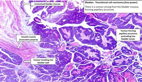 transitional cell carcinoma of urinary bladder