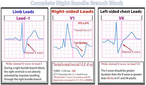 treatment for right bundle branch block