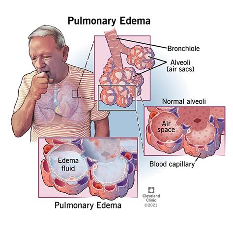 treatment of pulmonary congestion